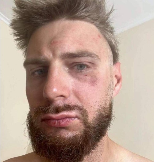 У Чехії поляки жорстоко побили волонтера-співвітчизника, прийнявши його за українц У Чехії поляки жорстоко побили волонтера-співвітчизника, прийнявши його за українц